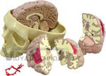 Diseased Brain in Skull Model